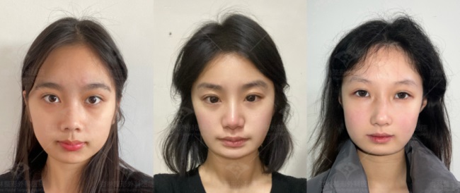 这三种特征不仅“显土气”还会“显脸胖”杏林改脸型(图1)