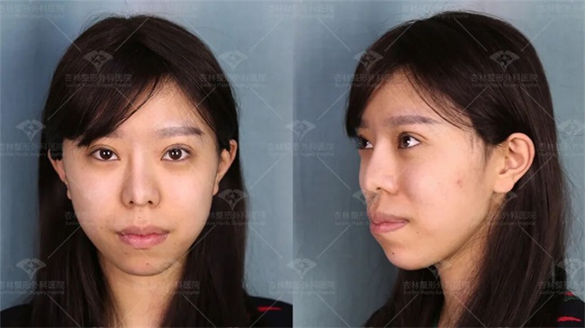 这三种特征不仅“显土气”还会“显脸胖”杏林改脸型(图6)