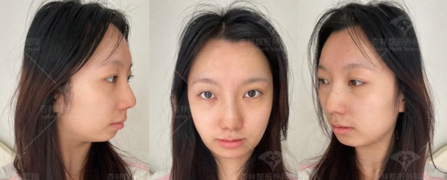 这三种特征不仅“显土气”还会“显脸胖”杏林改脸型(图8)