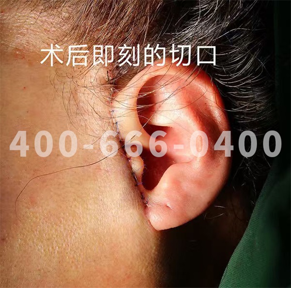 八大处整形赵延勇：为什么有的人拉皮后疤痕明显(图1)