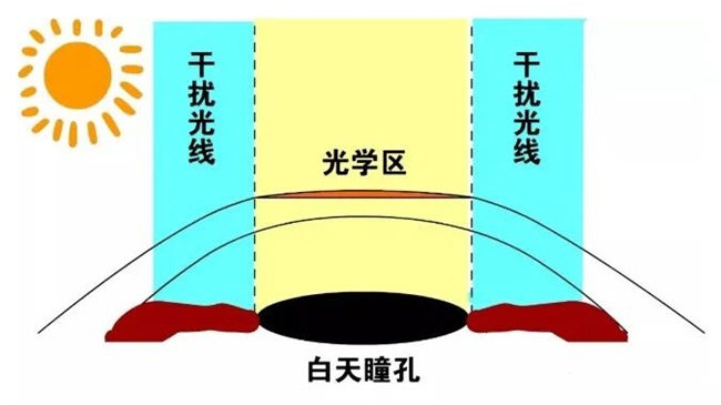 郑州近视手术术后眩光超全解答——尖峰眼科(图3) 郑州近视手术术后眩光超全解答——尖峰眼科(图3)