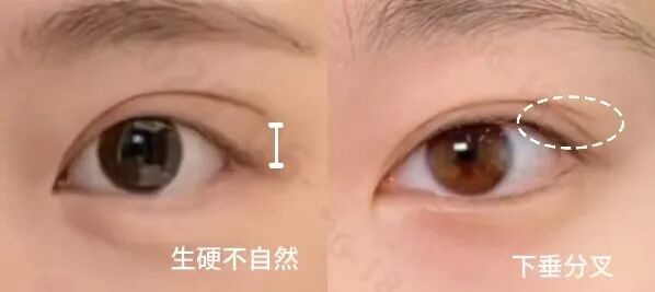 想做双眼皮，被「眼尾上扬」刷屏了？杏林眼综合(图6)