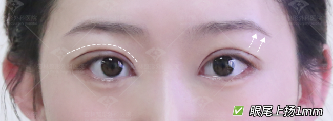 想做双眼皮，被「眼尾上扬」刷屏了？杏林眼综合(图8)